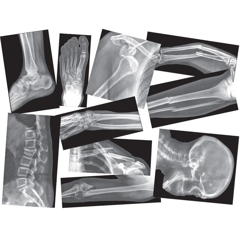  Broken Bones X- Ray Set, Pack Of 15